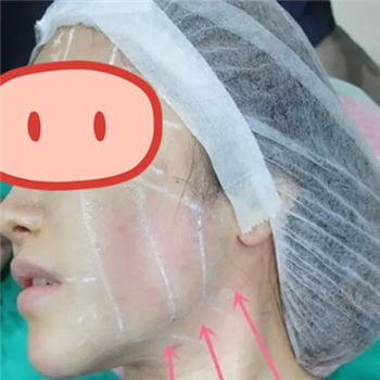 做音波拉皮除皺術(shù)一個月了，分享恢復(fù)過程和前后對比果圖片~