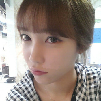 長沙美萊做了磨顴骨手術(shù)，分享恢復(fù)過程和前后對比果圖片~