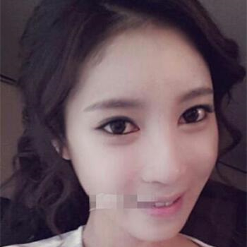 長沙美萊做了磨顴骨手術(shù)，分享恢復(fù)過程和前后對比果圖片~