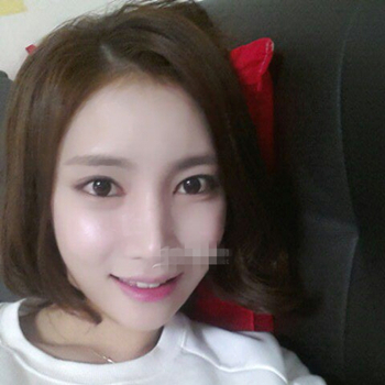 長沙美萊做了磨顴骨手術(shù)，分享恢復(fù)過程和前后對比果圖片~