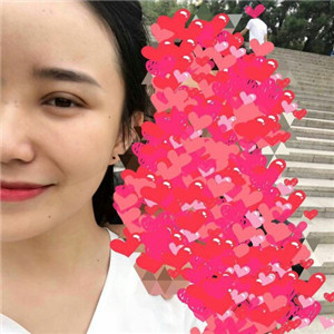 北京美萊做了雙眼皮手術(shù)，分享前后對比果圖片~