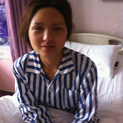 雙眼皮手術(shù)前后對(duì)比果照片分享，北京美萊做的~