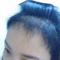 在雍禾植發(fā)醫(yī)院做微創(chuàng)微創(chuàng)植發(fā)經(jīng)歷分享，植發(fā)果很好