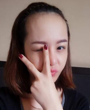 植發(fā)可以改良發(fā)際線