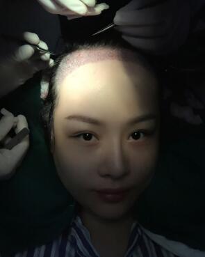 植發(fā)手術,將健康毛發(fā)組織移植到前額
