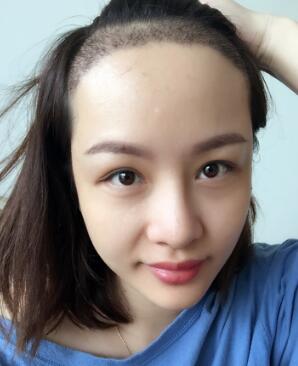 植發(fā),種發(fā)際線真實案例分享