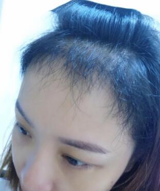 植發(fā)有五個月了