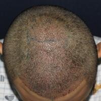 北京微創(chuàng)植發(fā)價格23800元，植發(fā)過程多圖對比分享