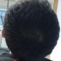 北京微創(chuàng)植發(fā)價格23800元，植發(fā)過程多圖對比分享