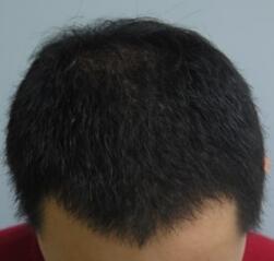 植發(fā)4個月了,期間有正常脫發(fā)