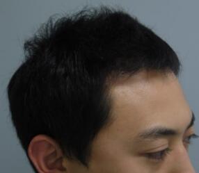 植發(fā)半年了,頭發(fā)沒有再掉落的情況,用手扒扯了一下,長的很牢固