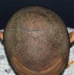 植發(fā)手術(shù)是7個醫(yī)生同臺手術(shù)的