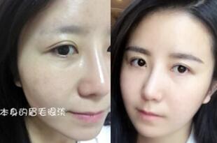 眉毛種植對比圖