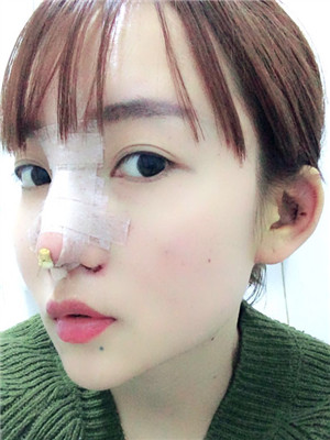 做完綜合鼻修復(fù)之后鼻子更加自然了