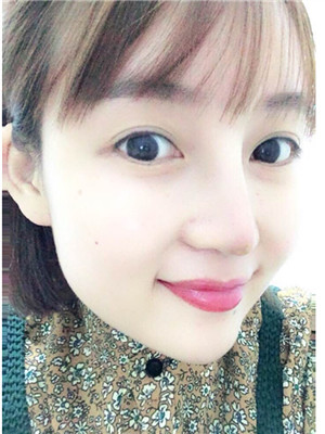 做完綜合鼻修復(fù)之后鼻子更加自然了