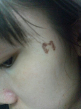 激光祛斑，還我靚白肌膚!