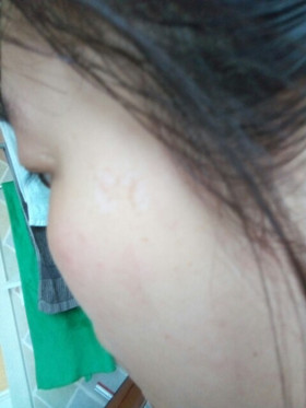 激光祛斑，還我靚白肌膚!