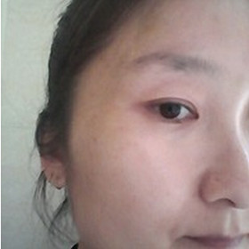 真人記錄了彩光嫩膚前后過程，果真的還不錯(cuò)