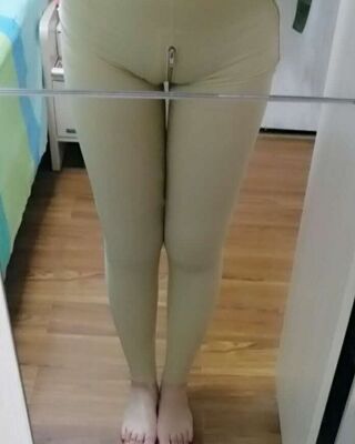 大腿抽脂的親身經(jīng)歷，恢復(fù)情況還不錯