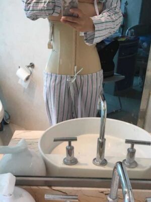 腰腹吸脂整形對比圖 肚子小了很多