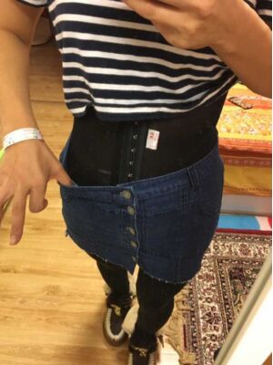 腰腹吸脂整形對比圖 肚子小了很多