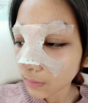 隆鼻整形日記，像變了個人似的