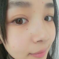 臉上激光去痣日志分享，一共去痣2次