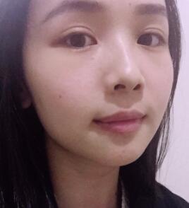 激光去痣恢復圖