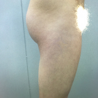 大腿抽脂瘦大腿恢復(fù)全過程我也有纖細(xì)的美腿了