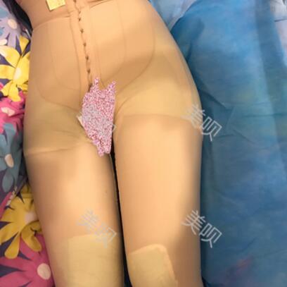 大腿抽脂瘦大腿恢復(fù)全過程我也有纖細(xì)的美腿了