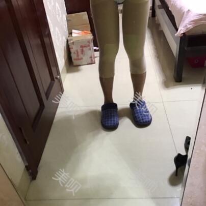 大腿抽脂瘦大腿恢復(fù)全過程我也有纖細(xì)的美腿了