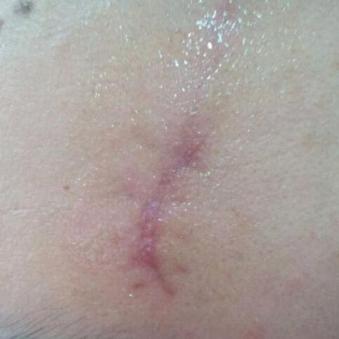 分享下我的手術(shù)切除祛疤過(guò)程路給大家做個(gè)參考