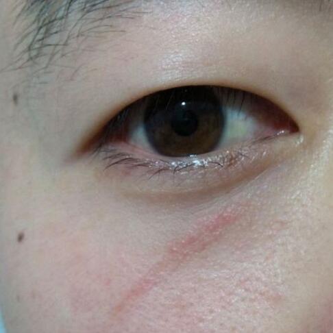 分享下我的手術(shù)切除祛疤過(guò)程路給大家做個(gè)參考