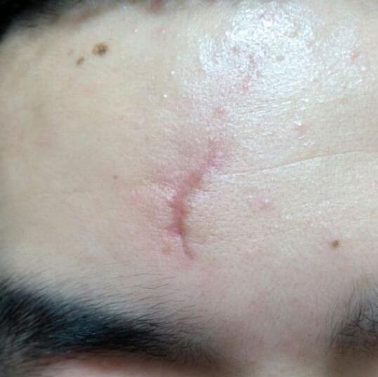 分享下我的手術(shù)切除祛疤過(guò)程路給大家做個(gè)參考