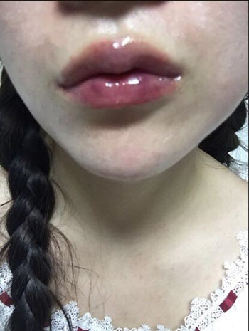 我做了玻尿酸豐唇和玻尿酸豐下巴 果還不錯(cuò)哦