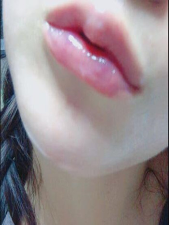 我做了玻尿酸豐唇和玻尿酸豐下巴 果還不錯(cuò)哦