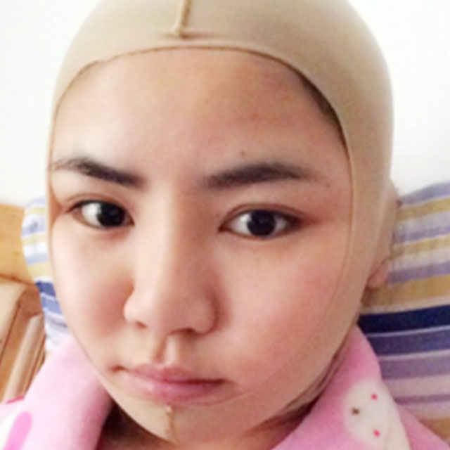 磨下頜角磨顴骨手術恢復過程和前后對比果照片分享哦~