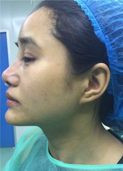 我做自體脂肪隆鼻手術恢復過程和前后對比果圖片分享哦~