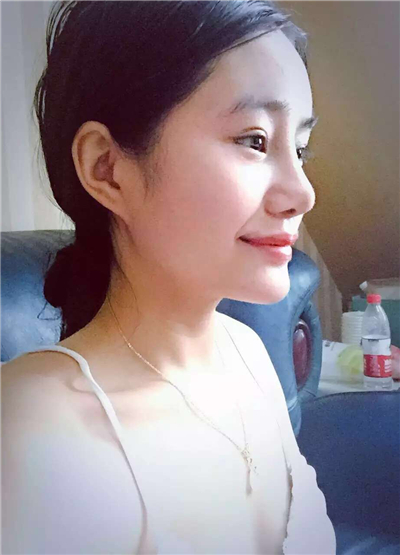 我做自體脂肪隆鼻手術恢復過程和前后對比果圖片分享哦~