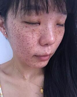 激光去雀斑真實經(jīng)歷分享