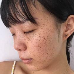 激光祛斑——雀斑后臉上終于白凈了