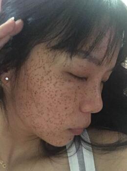 激光去雀斑術(shù)后照片