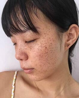 激光去雀斑對比圖