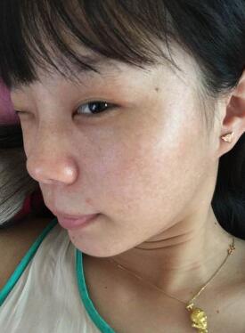 激光祛斑緩解果