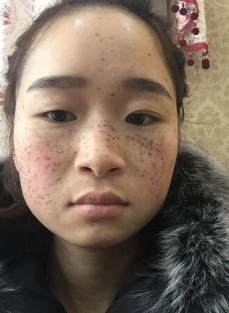 激光祛斑第二天開始結(jié)疤后的圖片