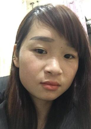 今天是激光祛斑第12天