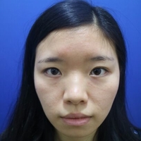 硅膠假體隆鼻+耳軟骨墊鼻尖大家看看果還不錯(cuò)吧