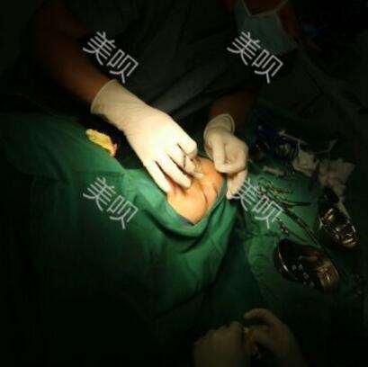 硅膠假體隆鼻+耳軟骨墊鼻尖大家看看果還不錯(cuò)吧