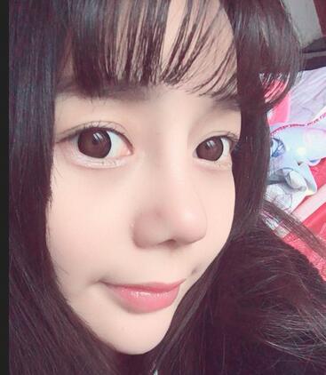 隆鼻修復術后恢復期經(jīng)歷