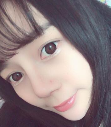 隆鼻修復術后恢復期經(jīng)歷